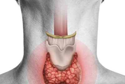 big-Tireoide